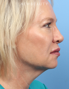 Dr. James Bouzoukis - Nonsurgical Rhinoplasty - After