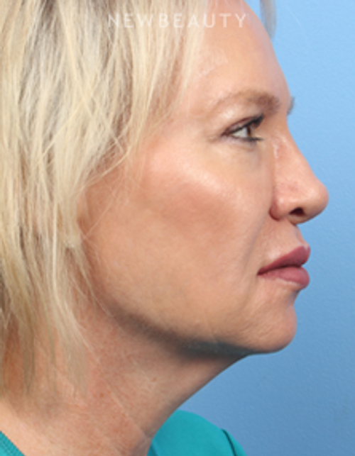 Dr. James Bouzoukis - Nonsurgical Rhinoplasty - After