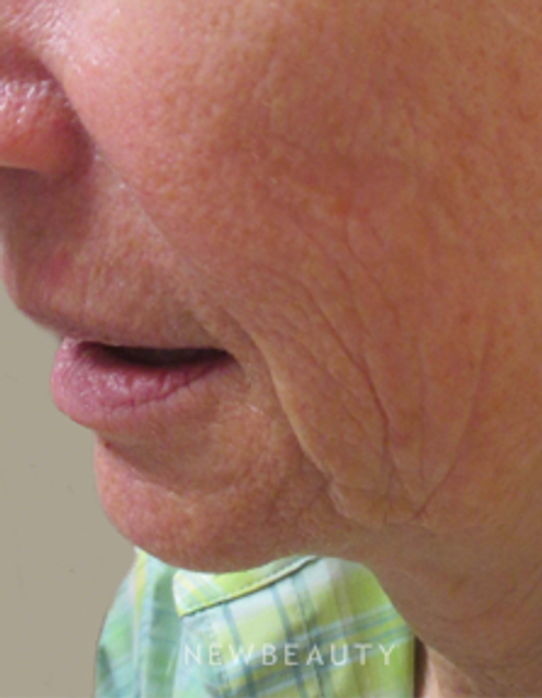 Dr. Kally Papantoniou - Ulthera - Before