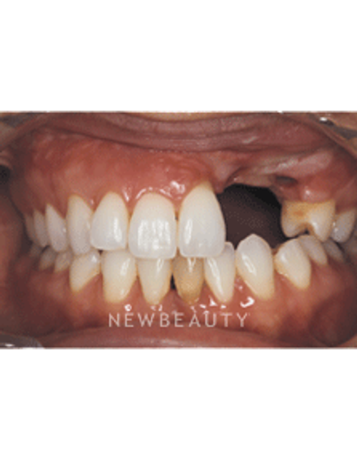 Dr. Neal Patel Crowns, Dental Implants, Smile Makeover - Before