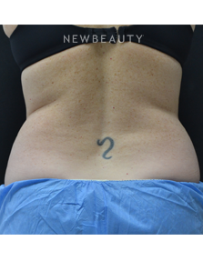 Dr. Julie Russak - CoolSculpting - After
