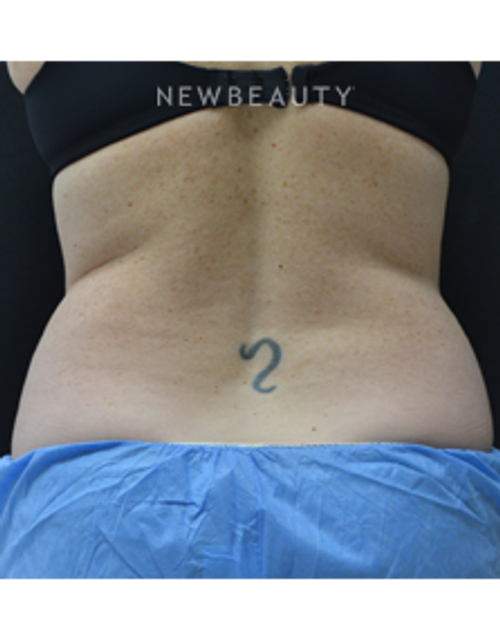 Dr. Julie Russak - CoolSculpting - After