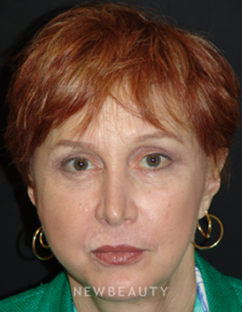 Dr. Mokhtar Asaadi Eyelid Lift, Facelift, Necklift - After