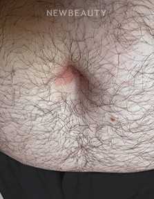 Dr. Anna Chacon -Cellulitis - 34278607 - After