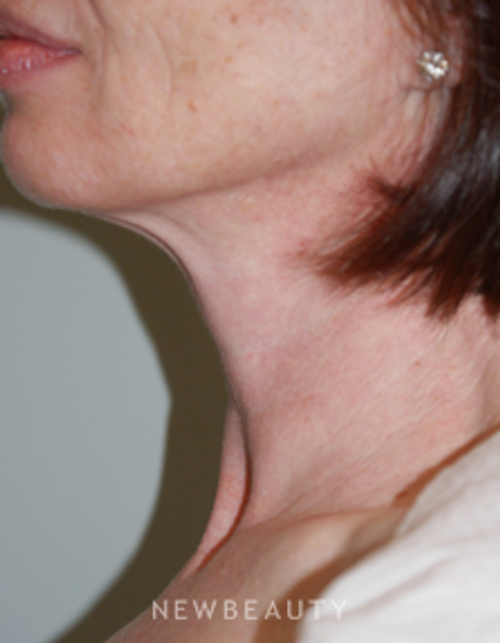 Dr. Marina Peredo Liposuction - After