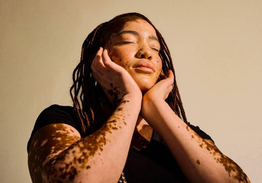 A young woman with vitiligo and braided hair rests her face in her hands with her eyes closed, sunlight falling across her skin, the depigmented patches visible on her face, neck and arms.