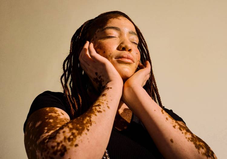 A young woman with vitiligo and braided hair rests her face in her hands with her eyes closed, sunlight falling across her skin, the depigmented patches visible on her face, neck and arms.