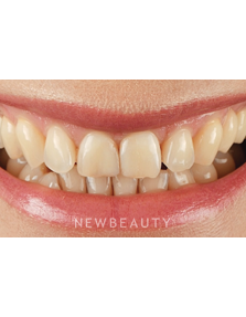 Dr. Husam Almunajed - Smile Makeover - Before