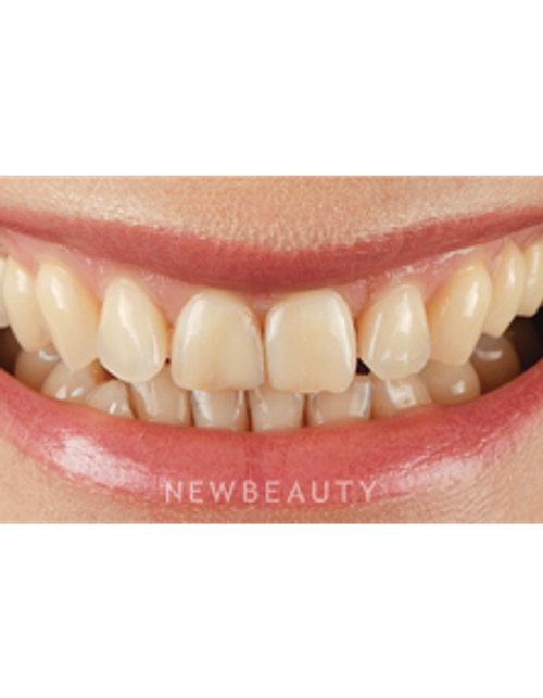 Dr. Husam Almunajed - Smile Makeover - Before