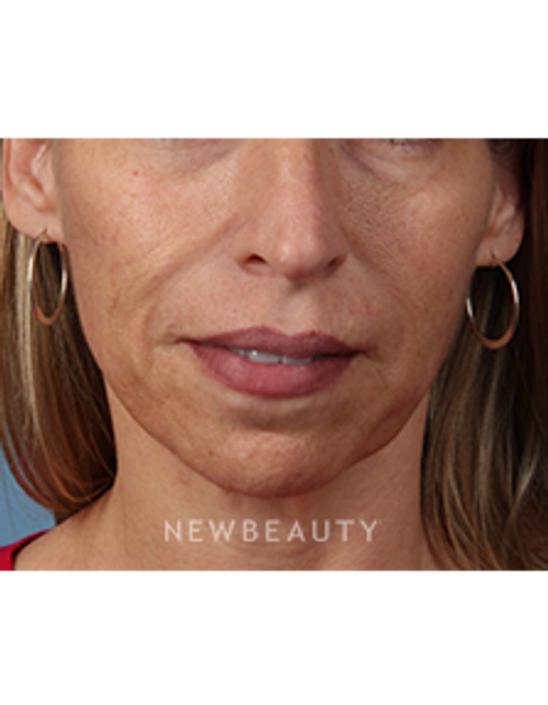 Dr. Kathleen Behr - Injectables - After