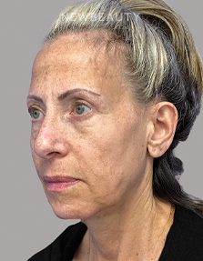 Dr. Dilip Madnani - Facelift -  45284088 - Before