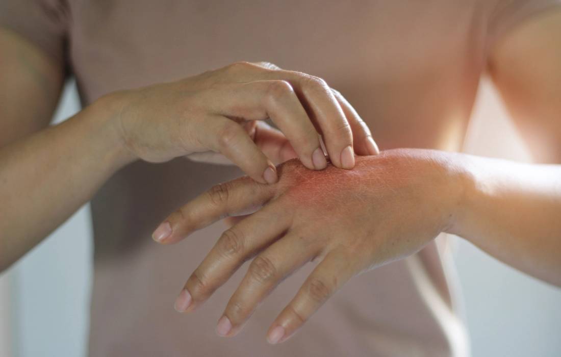 Close-up of a person scratching red, irritated skin on the back of their hand