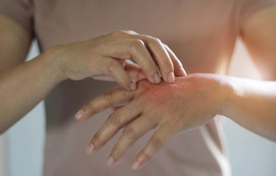 Close-up of a person scratching red, irritated skin on the back of their hand