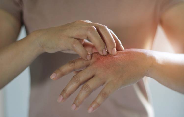 Close-up of a person scratching red, irritated skin on the back of their hand