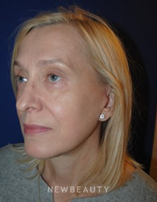 Dr. Lee Ann Klausner - Mini Facelift - After