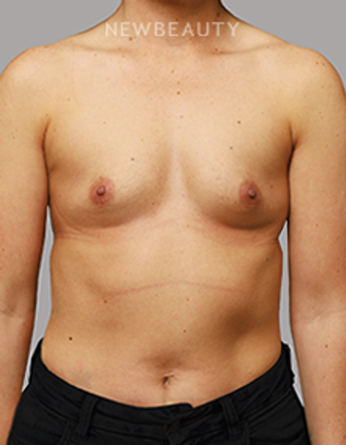 Dr. Kevin Rose - Breast Aug - 44290750 - Before