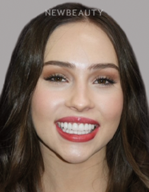Dr. Salvator La Mastra - Smile Makeover -46108811 - After