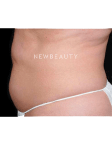 Dr. Ruth Hillelson Thermage - Before