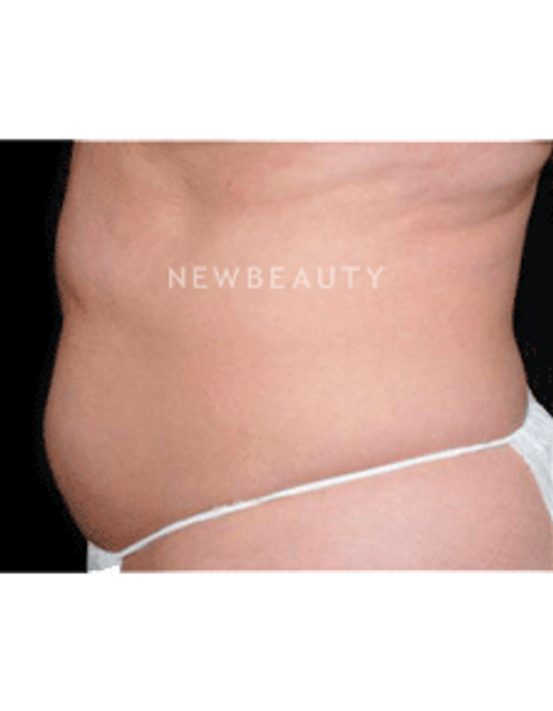 Dr. Ruth Hillelson Thermage - Before