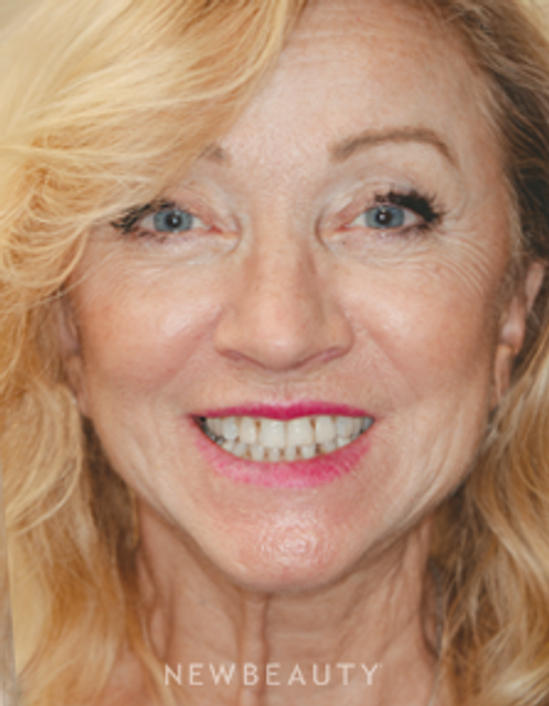 Dr. Irene Grafman - A More Youthful Smile - Before