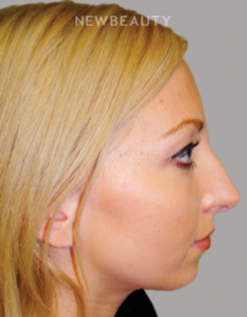Dr. Sanjay Grover - Rhinoplasty - 49727904 - Before
