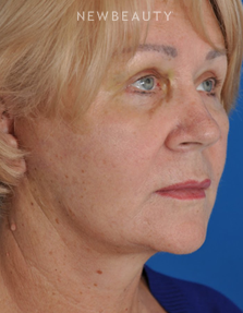 Dr. Edward Kwak - Facelift & Blepharoplasty - After