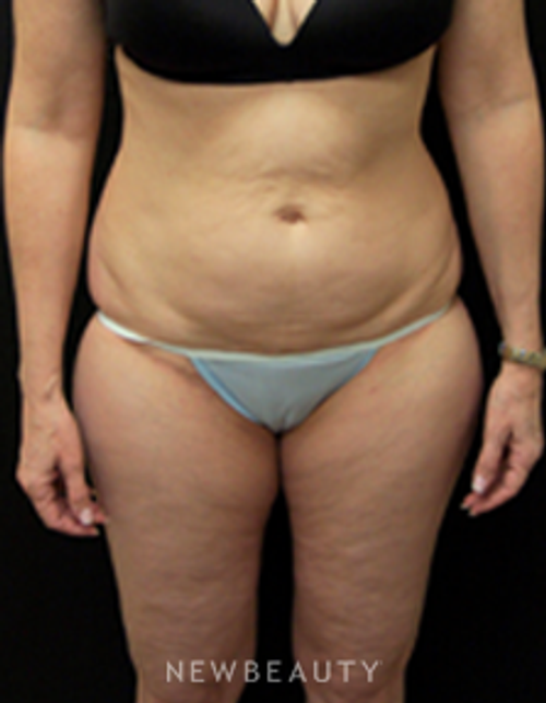 Dr. Mokhtar Asaadi Liposuction - Before