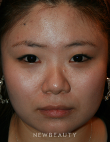 Dr. John Kang - Upper Blepharoplasty & Rhinoplasty - Before