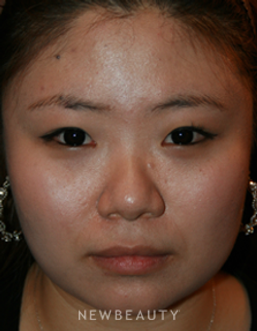 Dr. John Kang - Upper Blepharoplasty & Rhinoplasty - Before