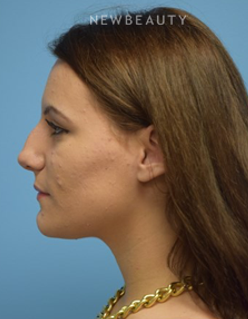 Dr. Jeffrey B. Wise- Rhinoplasty - Before