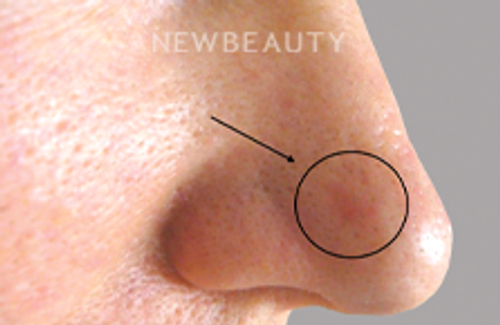 Dr. Deborah Longwill - Lip Filler - 46446227 - Before