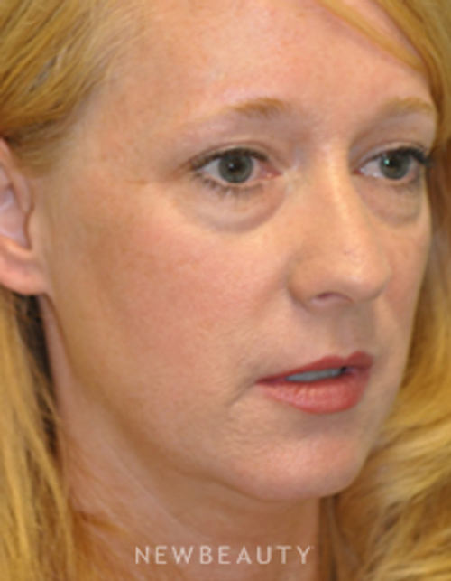 Drs. Lieberman & Parikh - Lower Blepharoplasty - Before