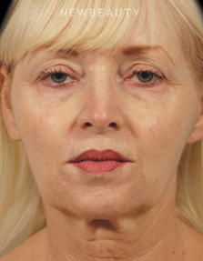 Dr. Kenneth Beer - Liquid Facelift - Before