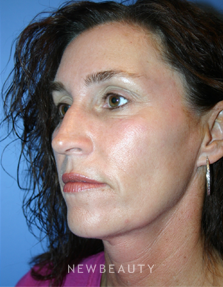 Dr. Kelly Bomer - Chemical Peels - After