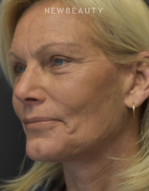 Drs. Lieberman & Parikh - Signature Facelift - After