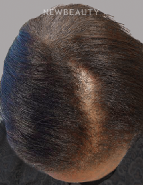 Dr. Valerie Calender - Hair Regrowth Treatment - 20905920 - Before