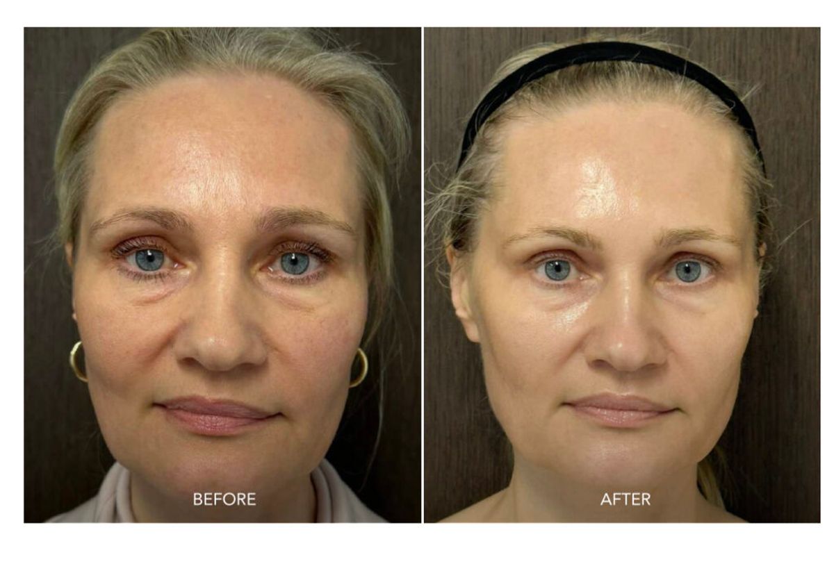 SKORR GLOW BEORE AND AFTER