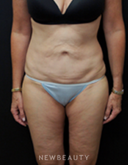 Dr. Mokhtar Asaadi Liposuction - After