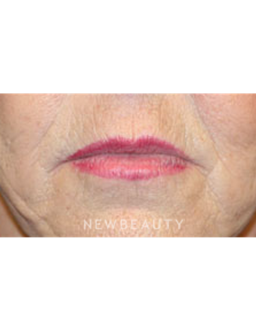Dr. Christine Hamori - Lip Lift - Before