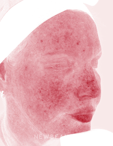 Dr. Kenneth Beer - Brightening Serum - After