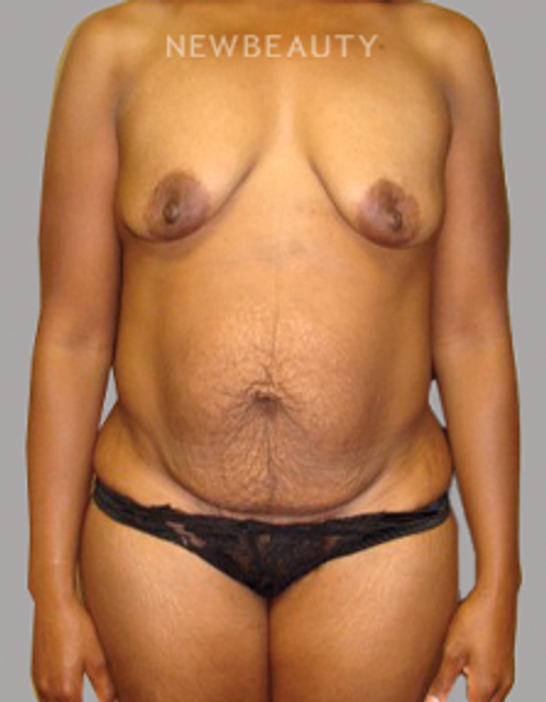Dr. Sanjay Grover - Mommy Makeover - 49714108 - Before