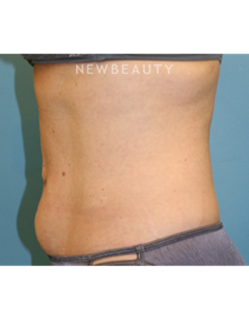 Dr. Christine Hamori - Tummy Tuck - Before