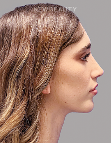 Dr. Paul Afrooz - Beautifully Balanced Results - - After