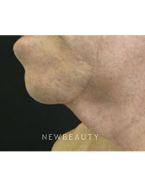Dr. Christine Hamori - Chin Augmentation - Before