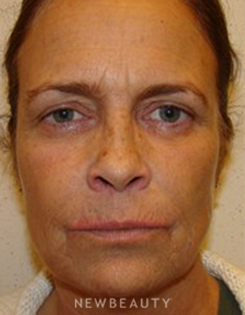 Dr. Joel Schlessinger - Injectables - Before