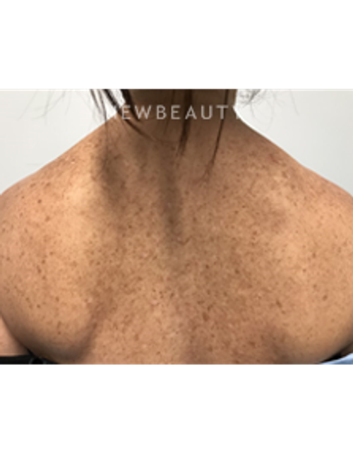 Dr. Marina Peredo - and more. Skinfluence “Trinity Treatment” - Before