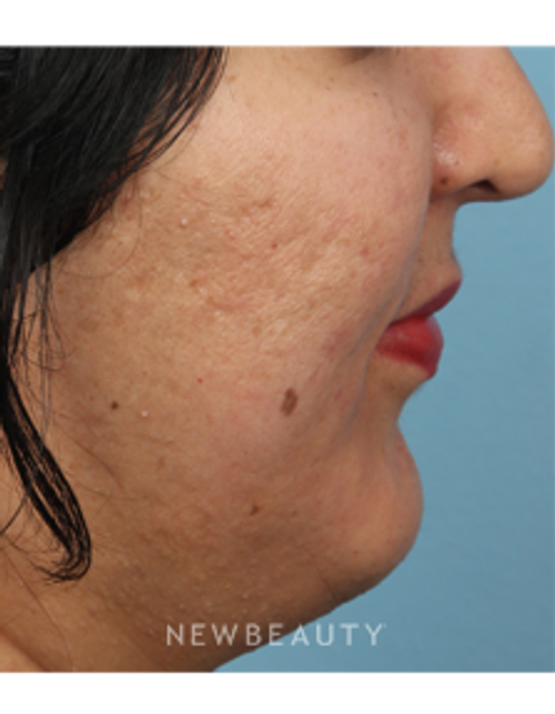 Dr. Kathleen Behr - Microneedling - After
