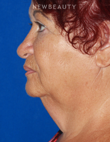 Dr. Konstantin Vasyukevich - Lower Facelift - Before
