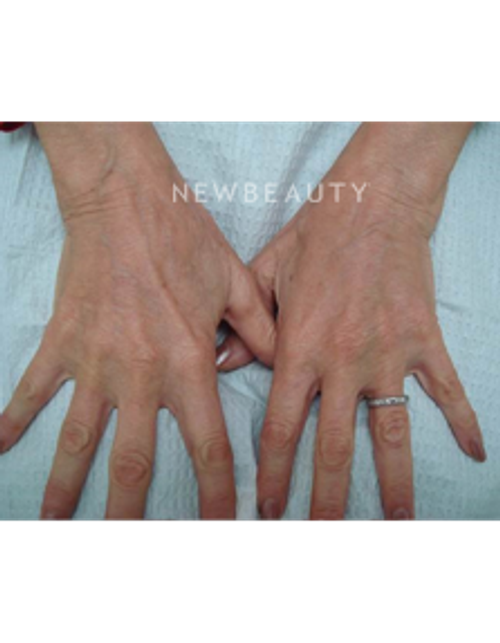 Dr. Doris Day - Injectables & Fillers - After