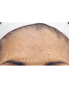 Dr. Jody Levine Lasers, Chemical Peel - Before